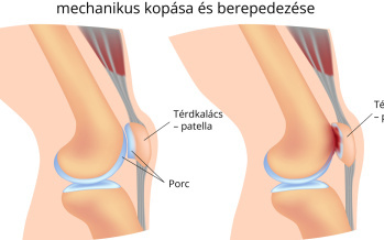 A térdkalács chondromalaciája