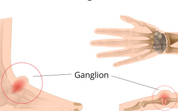 Ganglion