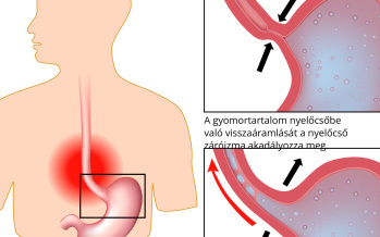Gyomorégés
