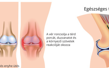 Hemartrózis