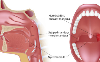 Herpangina