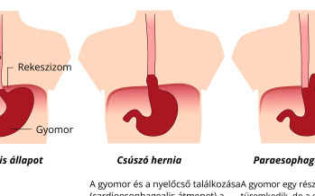 Hiátuszsérv