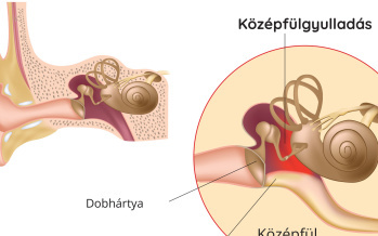 Masztoiditisz