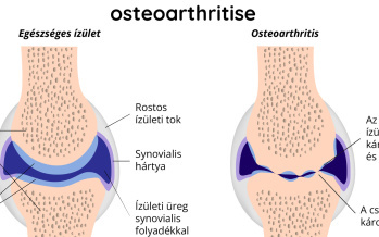 Oszteoartritisz