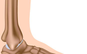 Plantáris fasciitis