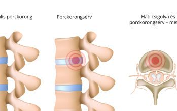 Porckorongsérv
