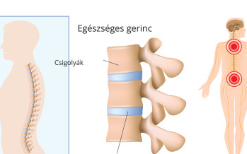 Radikulopátia