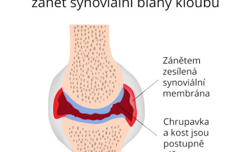 Szinovitisz