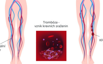 Visszér
