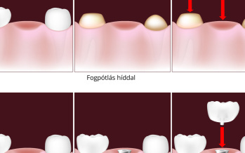 Fogászati implantátum vagy híd?