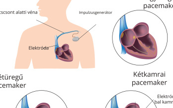 Pacemaker beültetése