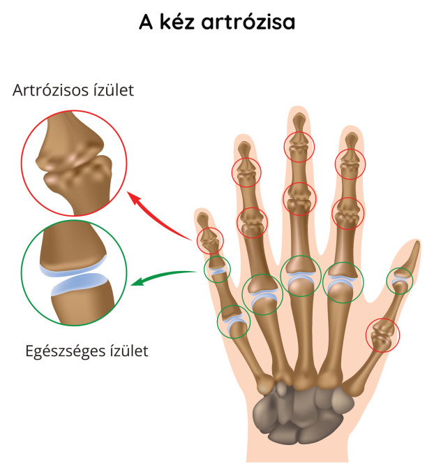 A kéz artrózisa