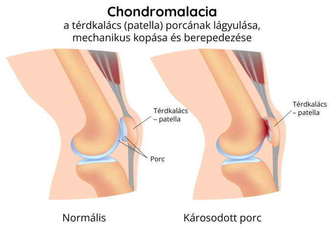 A térdkalács chondromalaciája (lágyulása)
