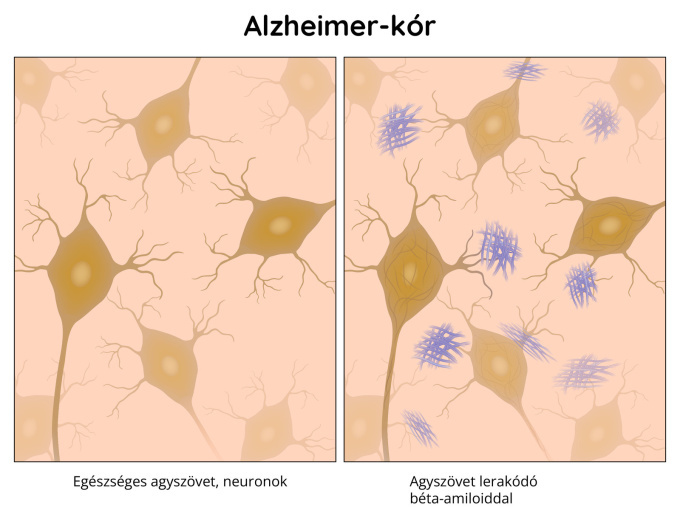 Alzheimer-kór