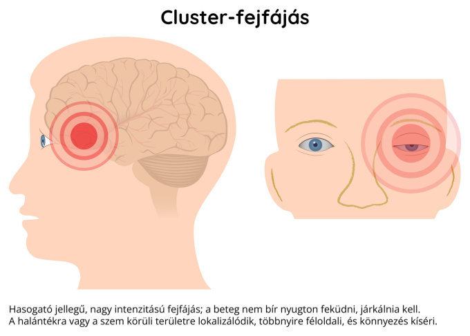 Cluster-fejfájás