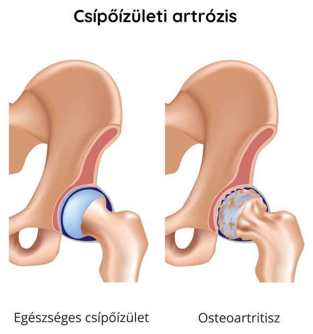 A csípőízület artrózisa