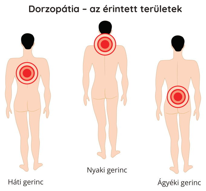 Dorzopátia – az érintett területek