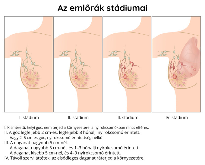 Az emlőrák stádiumai