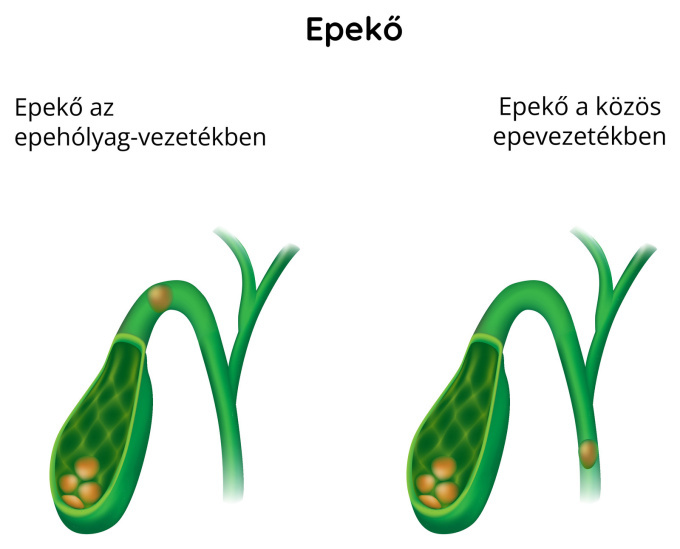 Epekövek
