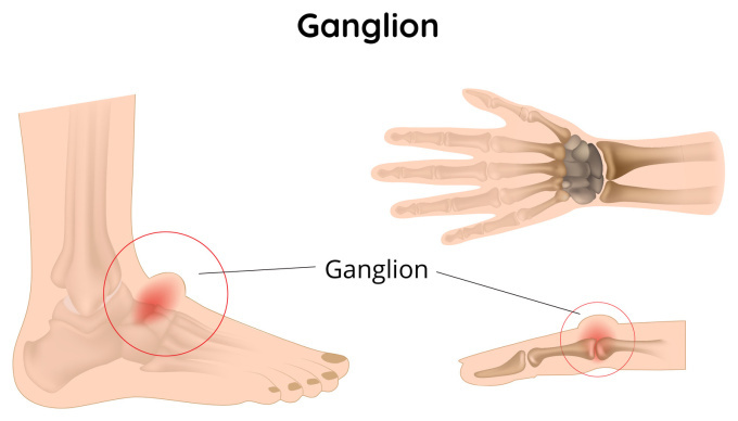 Ganglion a kézen és a lábon