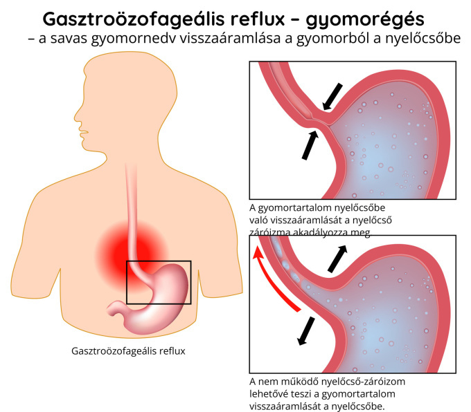 Gastroesophagealis reflux – gyomorégés