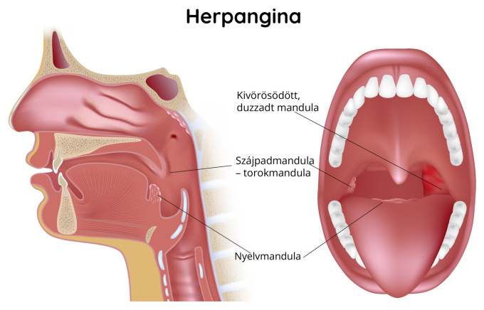 Herpangina – megnagyobbodott nyirokcsomók