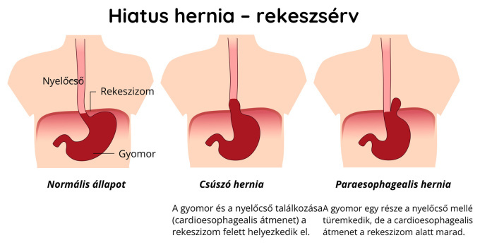 Hiátuszsérv – rekeszsérv