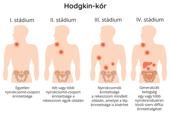 A Hodgkin-limfóma stádiumai