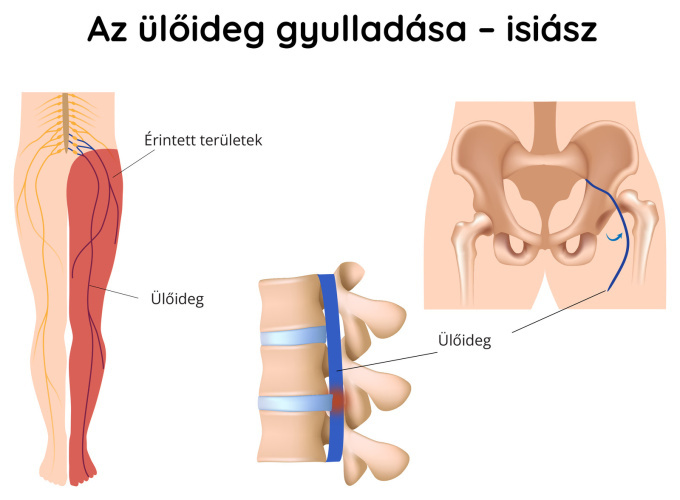 Az ülőideg gyulladása – isiász