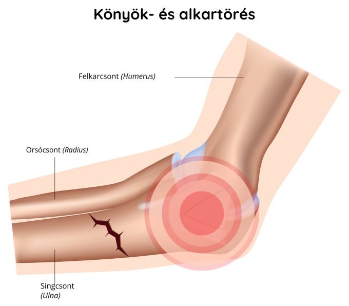 Törött könyök és alkar