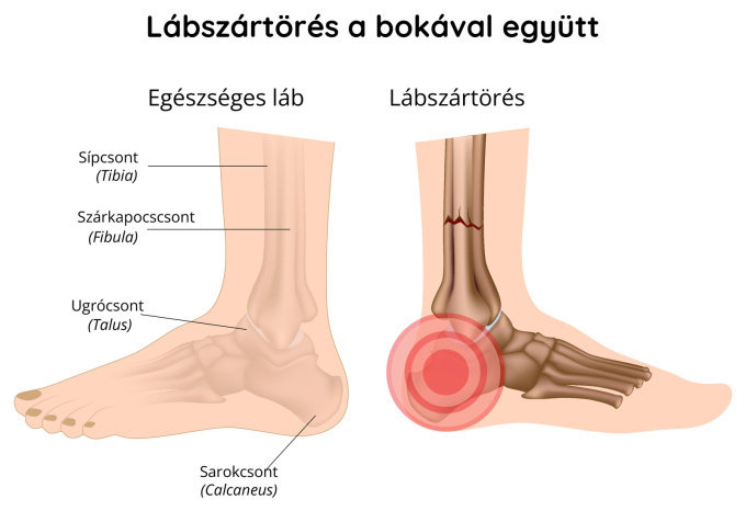 Törött boka