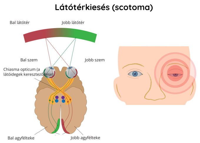 Látótérkiesés (szkotóma)