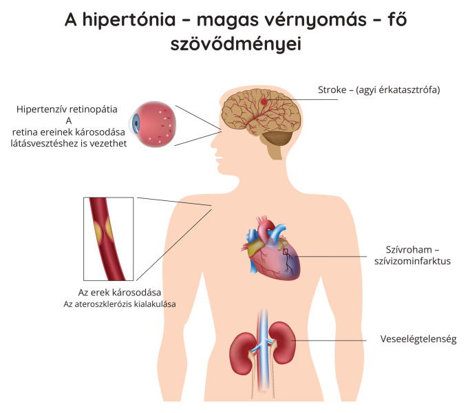 A hipertónia – magas vérnyomás – fő komplikációi