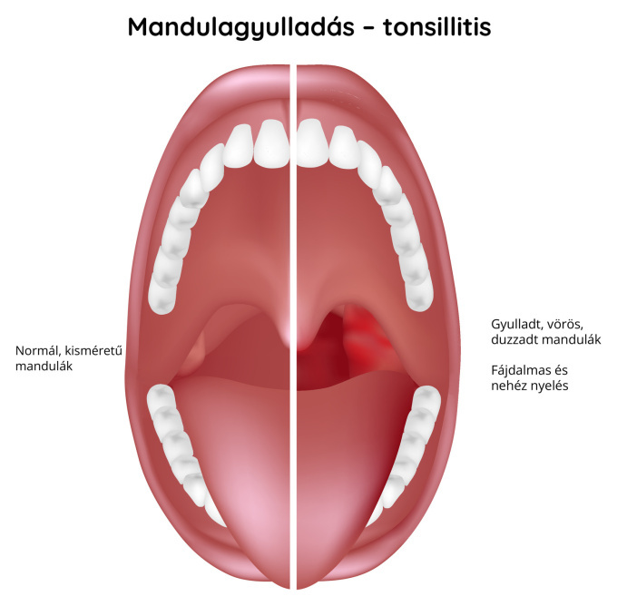 Mandulagyulladás – tonzillitisz