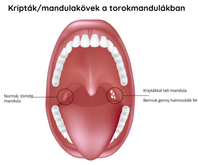 Kripták – dugók a mandulán
