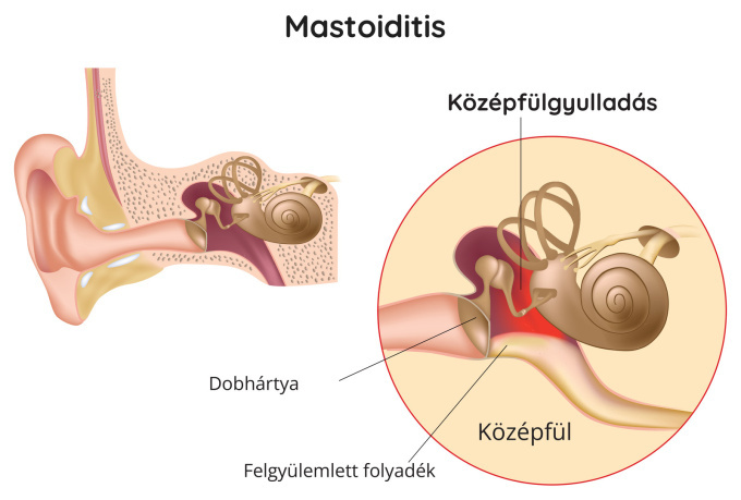 Középfülgyulladás