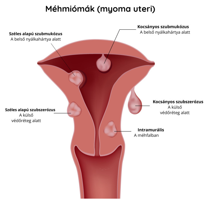 Méhfibroidok---miómák