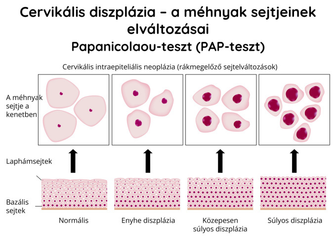 A cervix diszpláziája – a méhnyak sejtjeinek elváltozásai