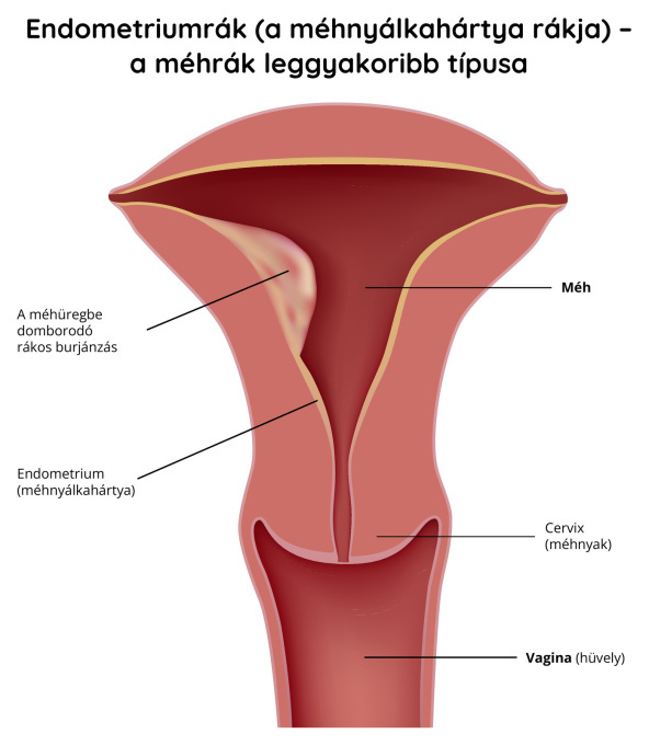 Az endometrium (méhnyálkahártya) rákja – a méhrák leggyakoribb típusa