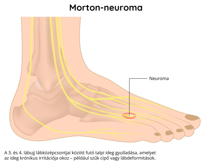 Morton-neuróma