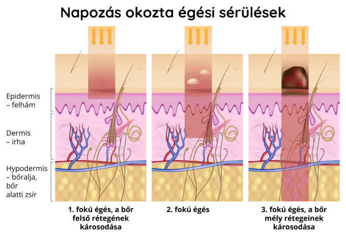 Napozás okozta égési sérülés