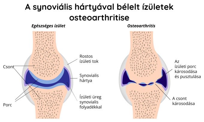 A szinoviális bélésű ízületek oszteoartritisze