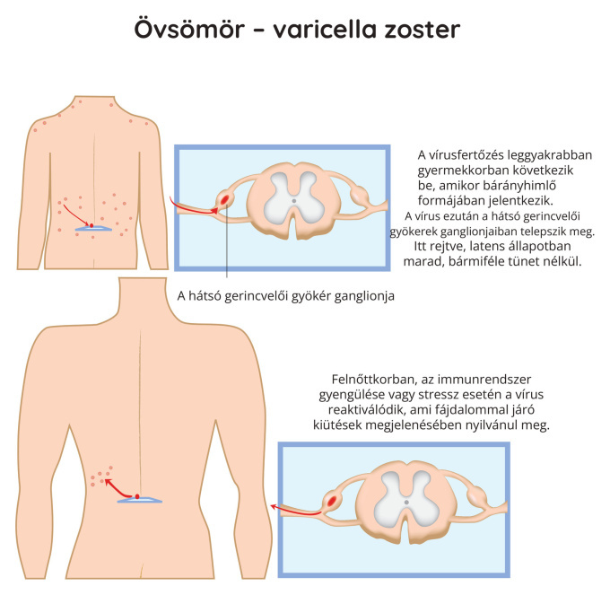 Övsömör – varicella zoster