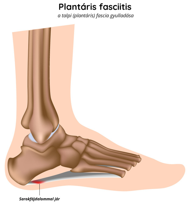 Plantáris fasciitis – a talpi fascia gyulladása
