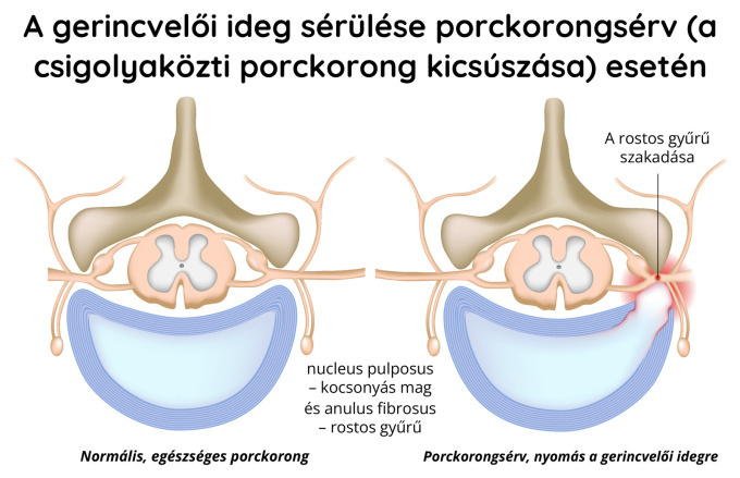 A gerincvelői ideg sérülése porckorongsérv (hernia) esetén