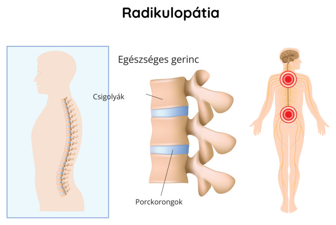 Radikulopátia