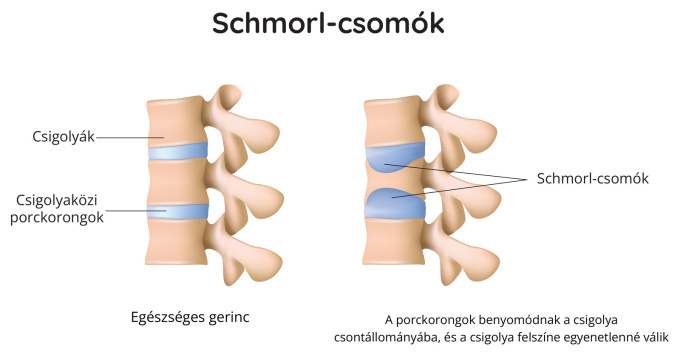 Schmorl-csomók