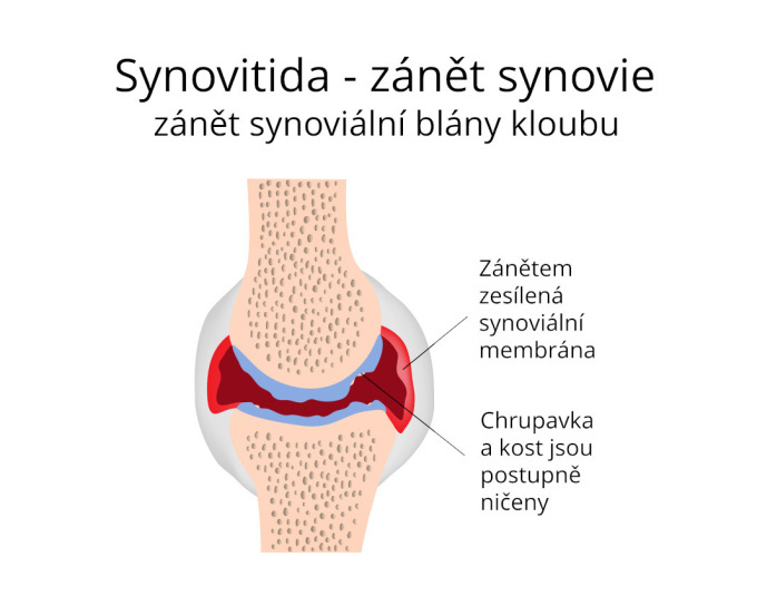 Szinovitisz – az ízületi szinoviális hártya gyulladása