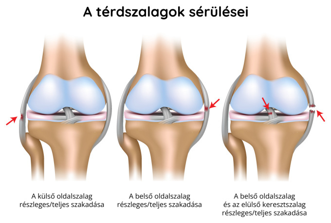 A térdszalagok sérülése