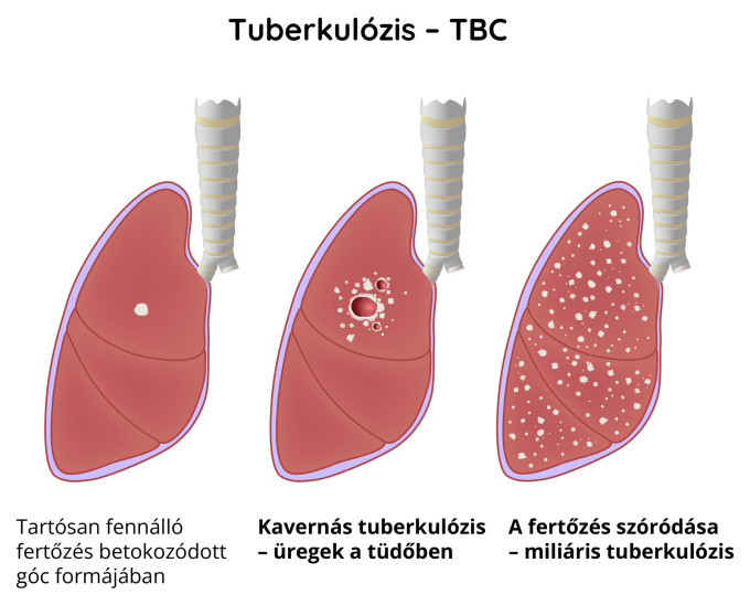 Tuberkulózis (TBC)